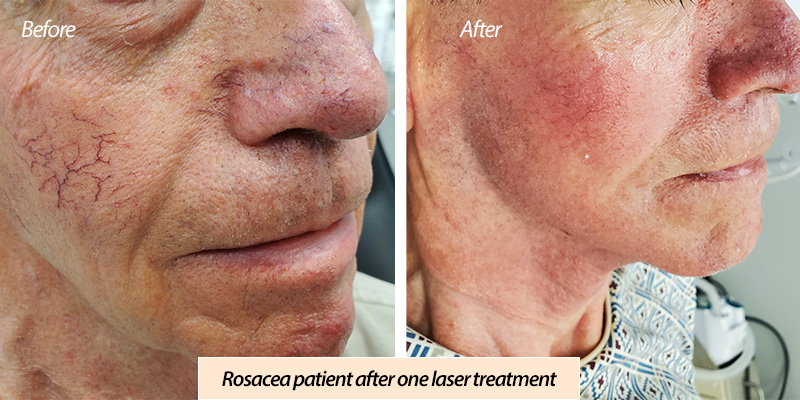 Rosacea patient laser treatment before and after photo