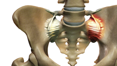 Pelvis SIJ Pain