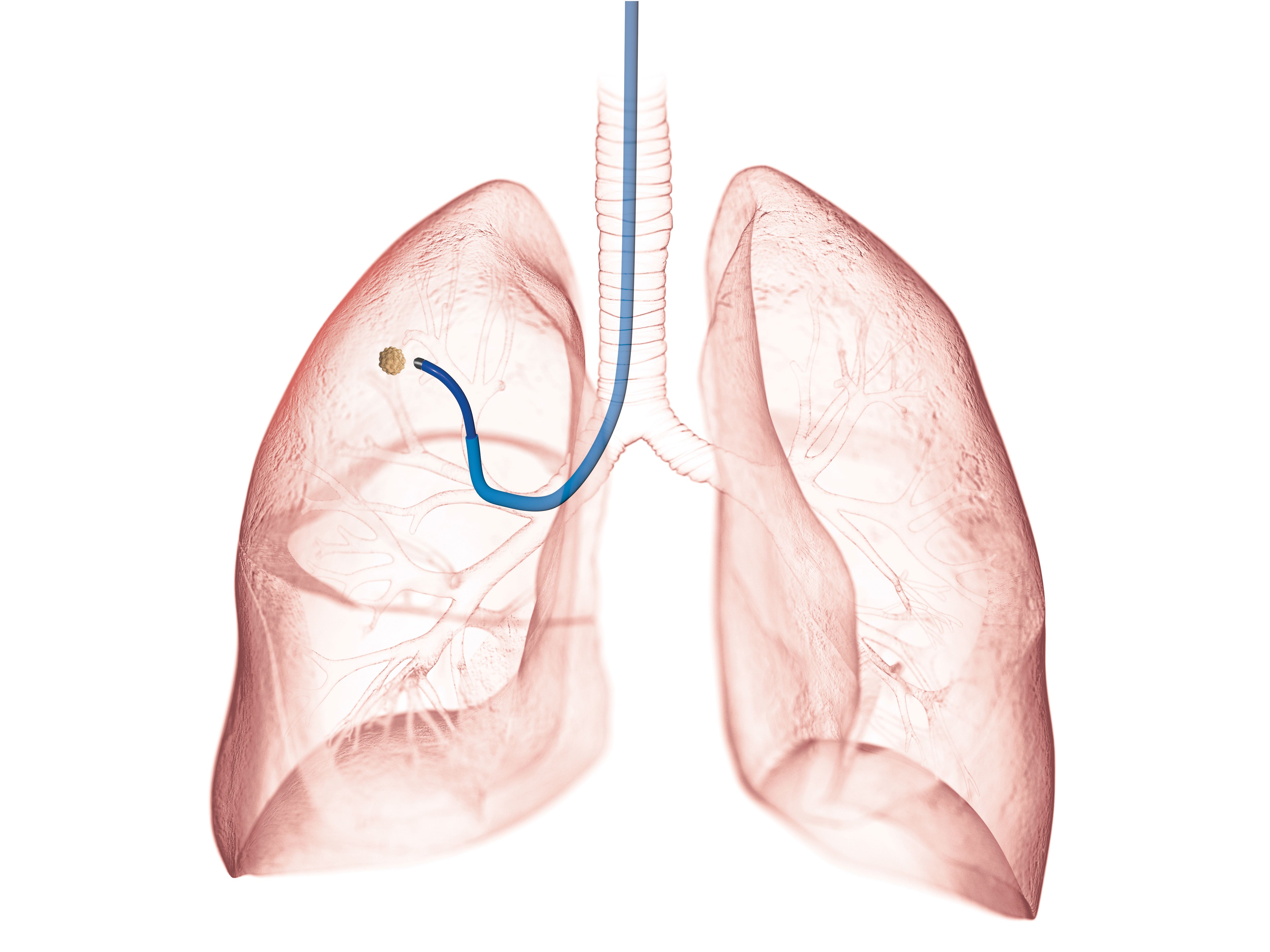 robotic bronchoscopy
