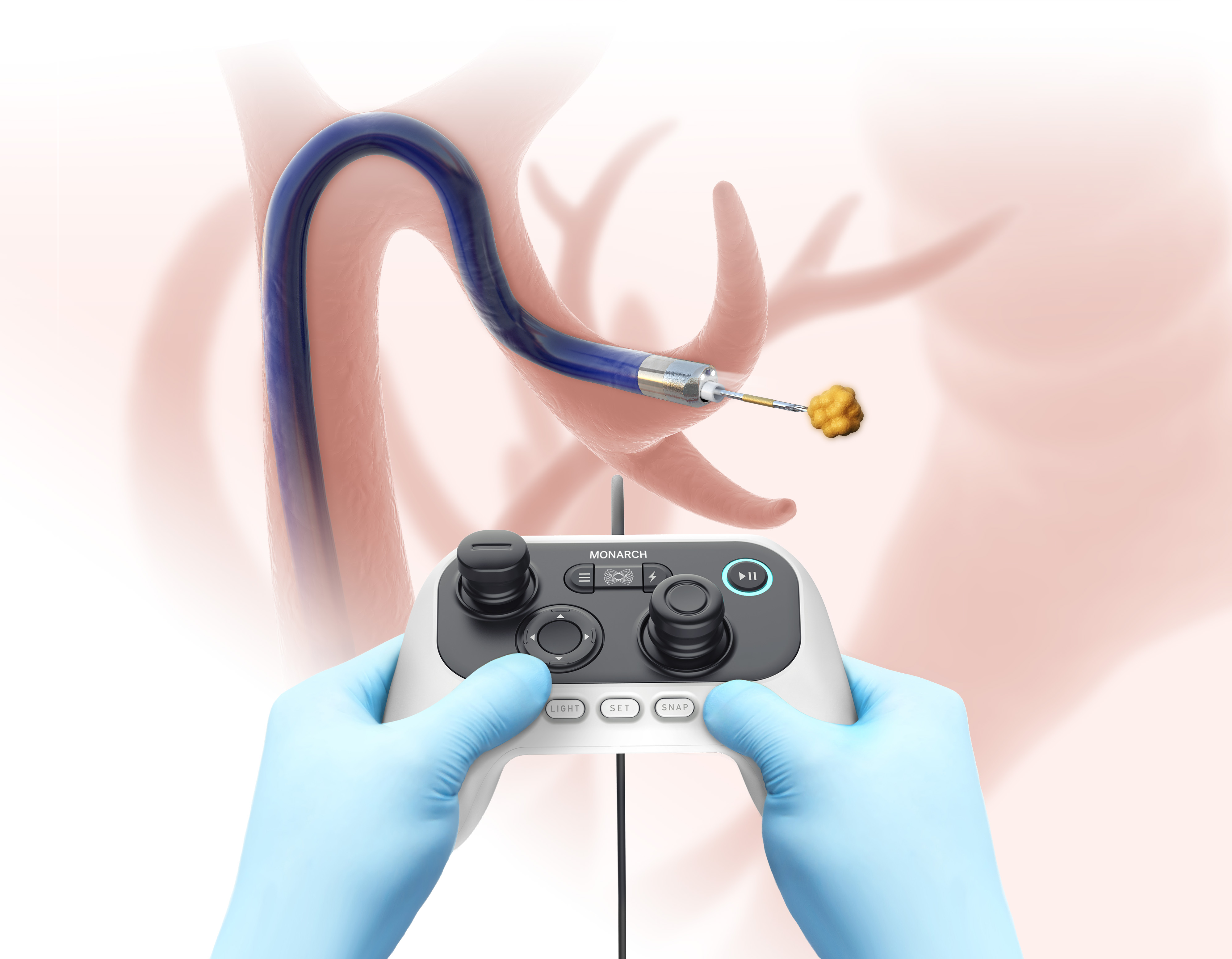 Monarch robotic bronchoscopy